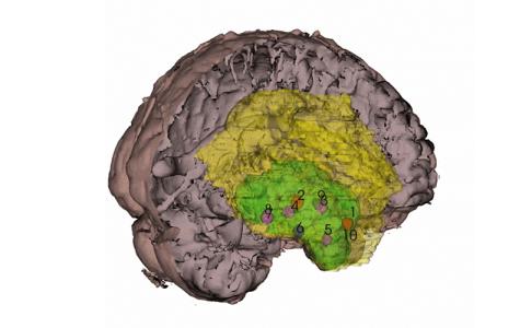 3D representation of individual patient's tumor showing where samples were taken for genomic and epigenomic analyses